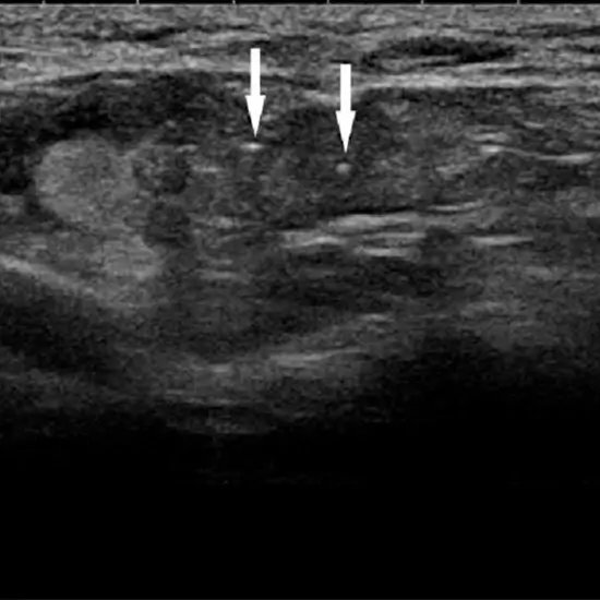 Ultrasound Axilla (Left/Right)